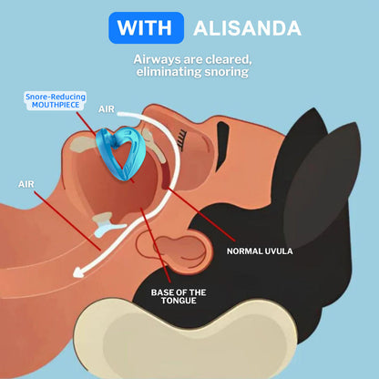 LAST DAY SALE 60% OFF ⏰ PerfectSleep Solution – Snore-Reducing & Teeth-Grinding Guard